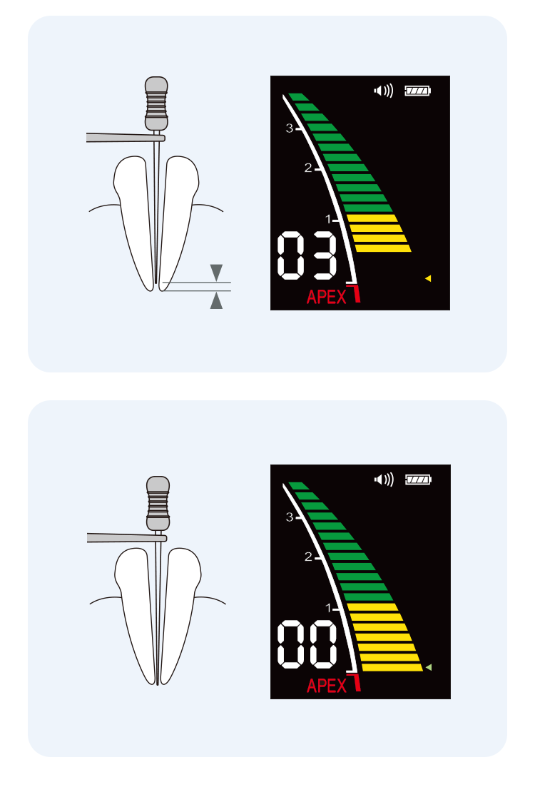Pro-PEX (APEX LOCATOR) - Image 10